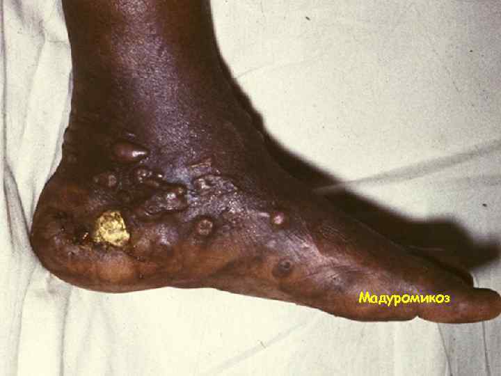 Мадуромикоз 