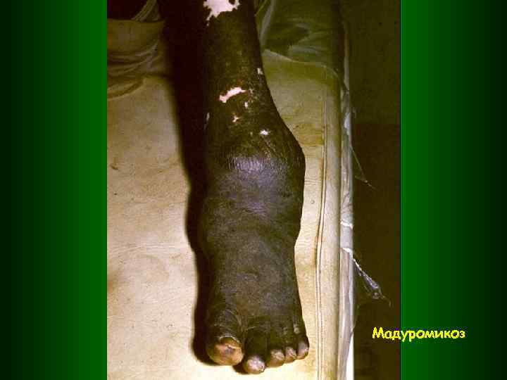 Мадуромикоз 
