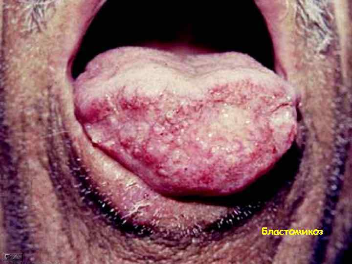 Бластомикоз 