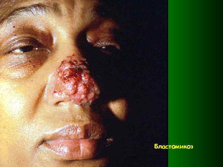 Бластомикоз 