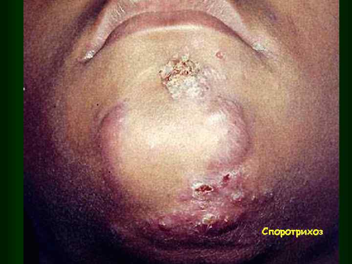 Споротрихоз 