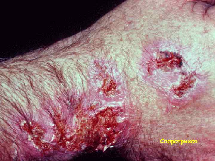 Споротрихоз 