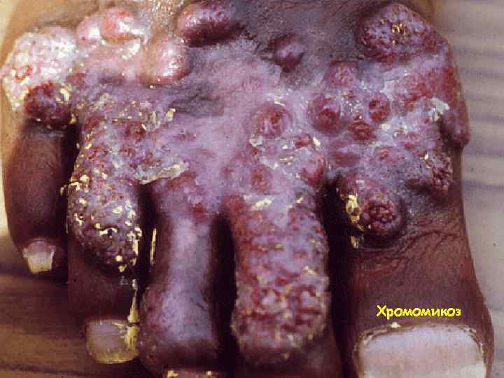 Хромомикоз 