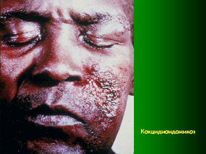 Кокцидиоидомикоз 