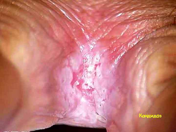 Кандидоз 