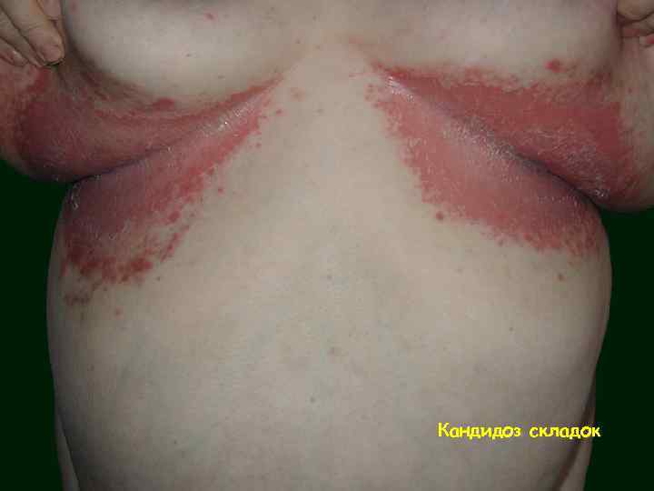 Кандидоз складок 