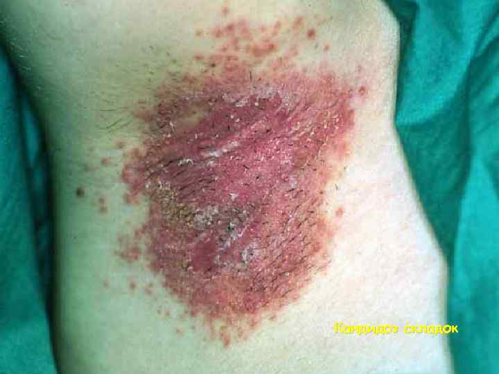 Кандидоз складок 