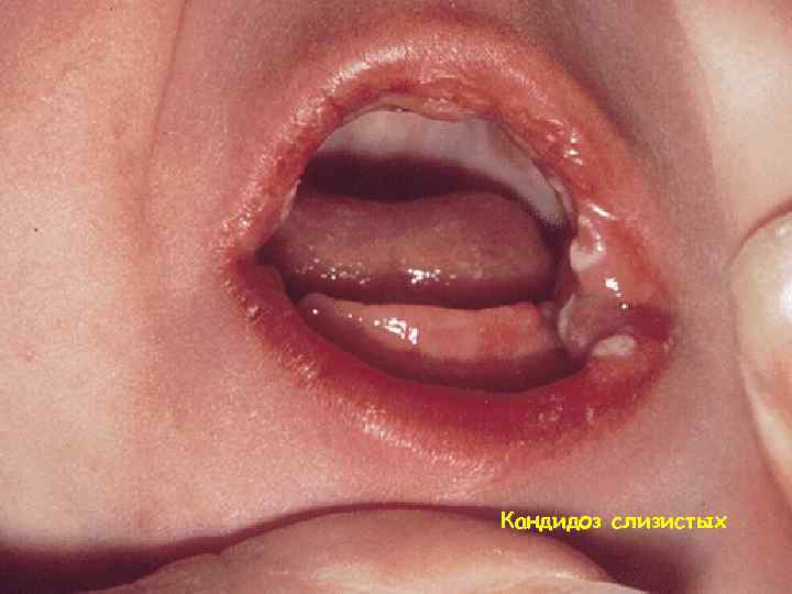 Кандидоз слизистых 