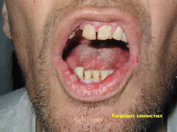 Кандидоз слизистых 