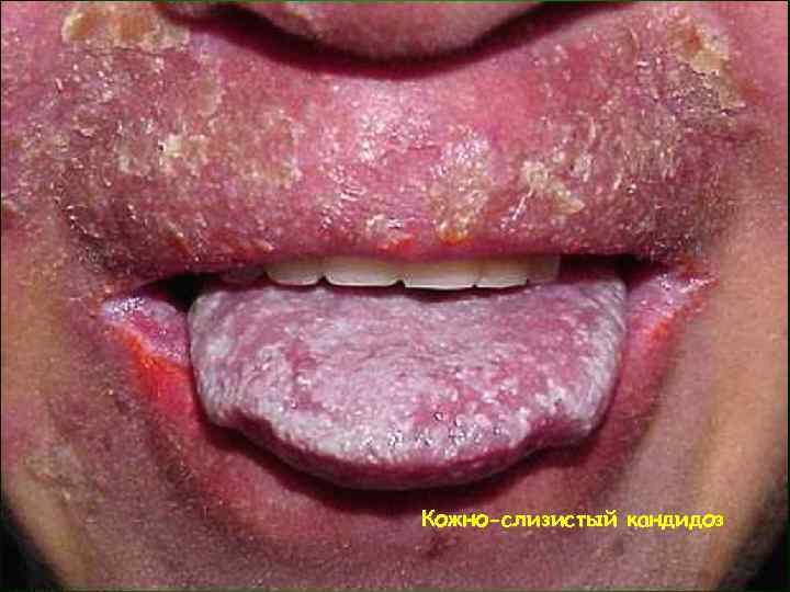 Кожно-слизистый кандидоз 