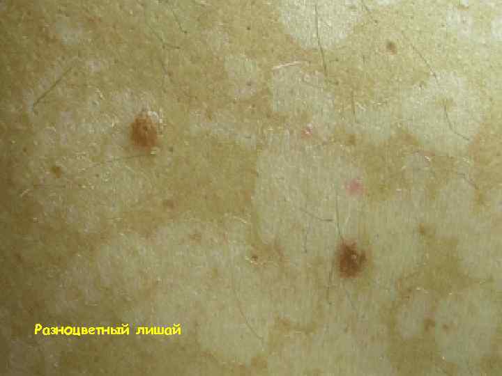 Разноцветный лишай 