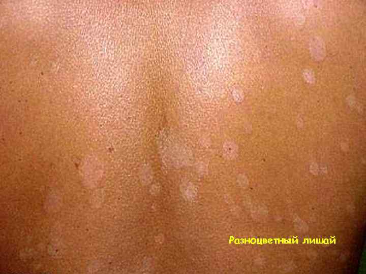 Разноцветный лишай 
