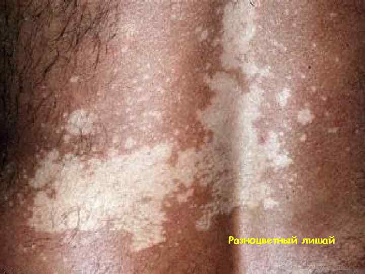 Разноцветный лишай 