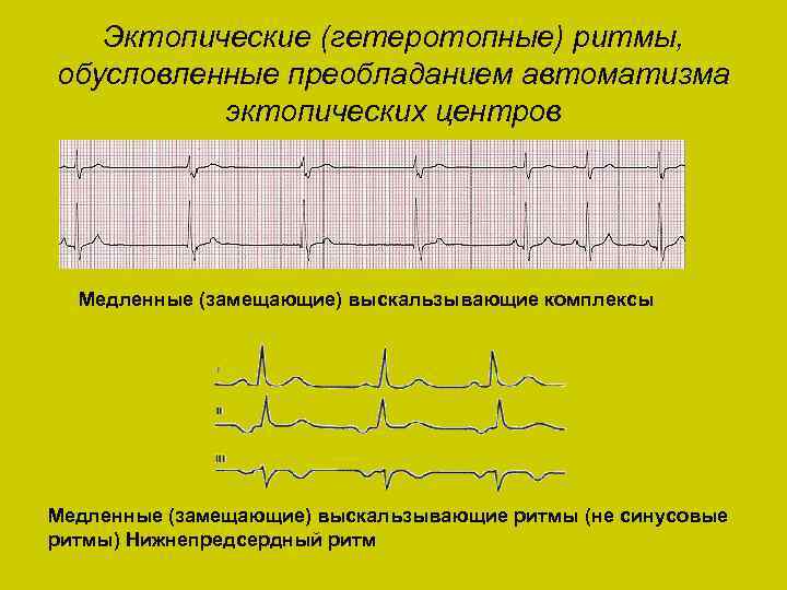 Эктопический ритм