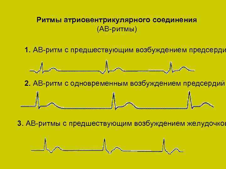 Ритмы атриовентрикулярного соединения (АВ ритмы) 1. AB ритм с предшествующим возбуждением предсерди 2. AB