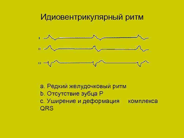 Идиовентрикулярный ритм а. Редкий желудочковый ритм b. Отсутствие зубца Р с. Уширение и деформация