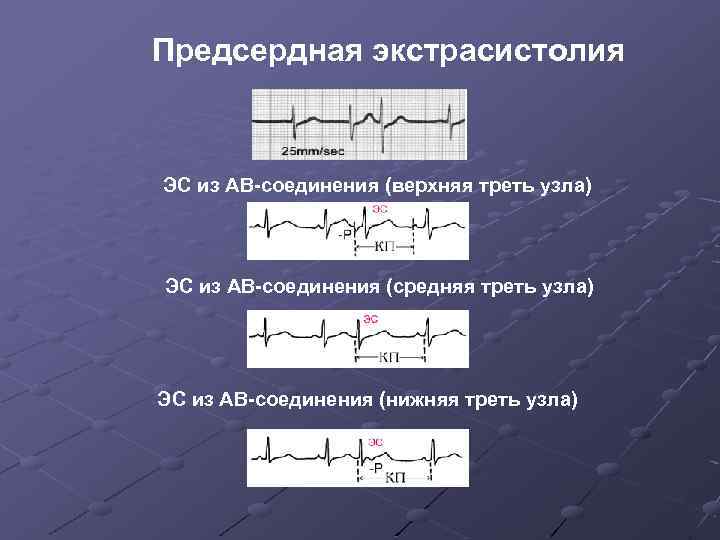 Предсердная экстрасистолия ЭС из АВ-соединения (верхняя треть узла) ЭС из АВ-соединения (средняя треть узла)