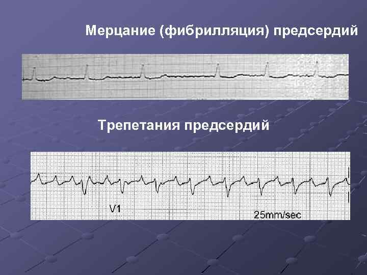 Фибрилляция предсердий. Трепетание фибрилляция и мерцание. Фибрилляция и мерцание предсердий. Мерцание и трепетание предсердий на ЭКГ. Трепетание и фибрилляция предсердий на ЭКГ.