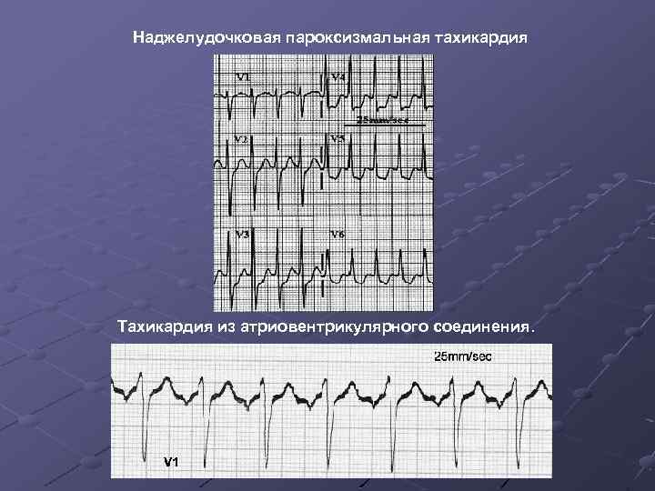 Что такое пароксизмальная тахикардия. Суправентрикулярная наджелудочковая тахикардия. Суправентрикулярная тахикардия ЭКГ. ЭКГ при пароксизмальной наджелудочковой тахикардии. Наджелудочковая аритмия ЭКГ.