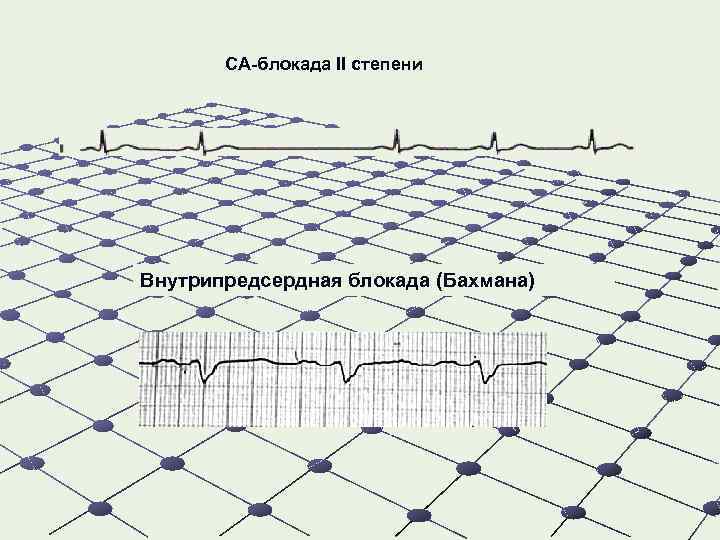 СА-блокада II степени Внутрипредсердная блокада (Бахмана) 