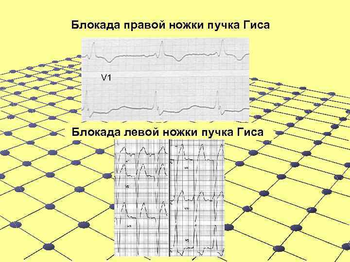 Блокада правой ножки пучка Гиса V 1 Блокада левой ножки пучка Гиса 
