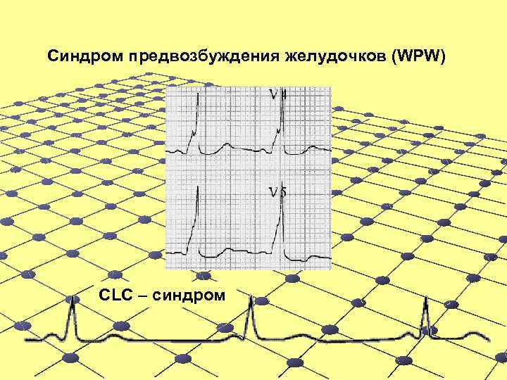 Синдром предвозбуждения желудочков (WPW) CLC – синдром 