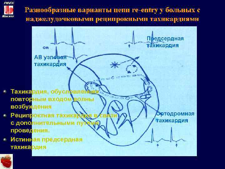 Тахикардия, обусловленная повторным входом волны возбуждения Реципроктная тахикардия в связи с дополнительными путями проведения.