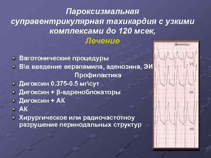 Пароксизмальная суправентрикулярная тахикардия с узкими комплексами до 120 мсек, Лечение Ваготонические процедуры Вв введение