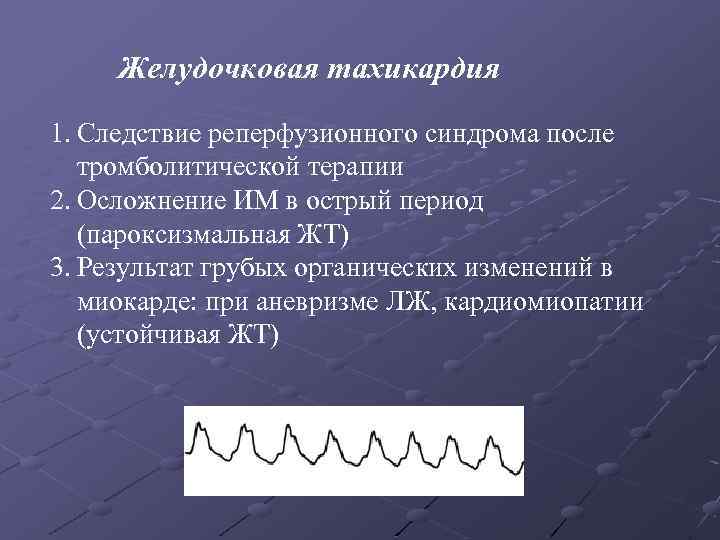 Желудочковая тахикардия 1. Следствие реперфузионного синдрома после тромболитической терапии 2. Осложнение ИМ в острый