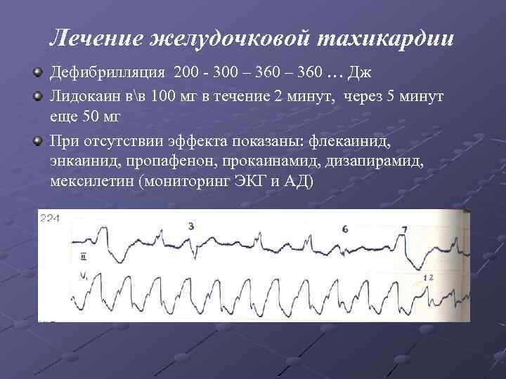 Лечение желудочковой тахикардии Дефибрилляция 200 - 300 – 360 … Дж Лидокаин вв 100