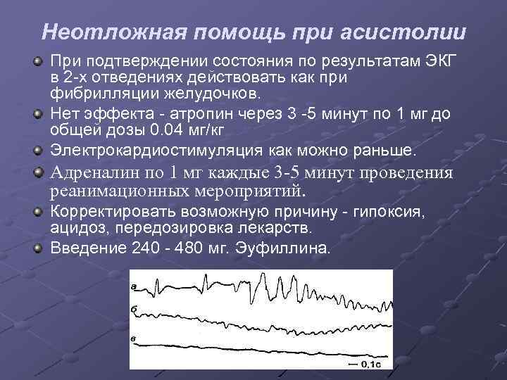 Асистолия на экг фото