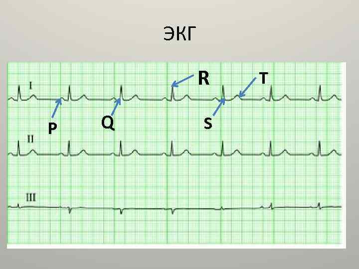ЭКГ R Р Q S T 