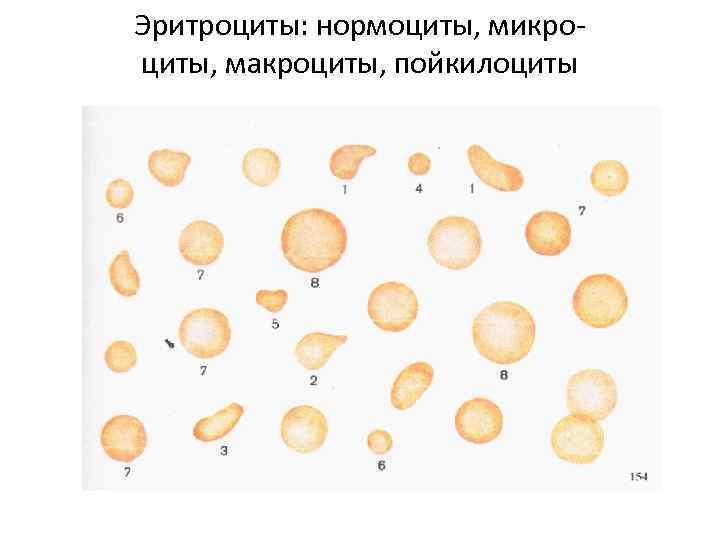 Эритроциты: нормоциты, микроциты, макроциты, пойкилоциты 
