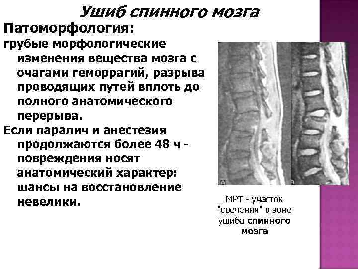 Ушиб спинного мозга Патоморфология: грубые морфологические изменения вещества мозга с очагами геморрагий, разрыва проводящих