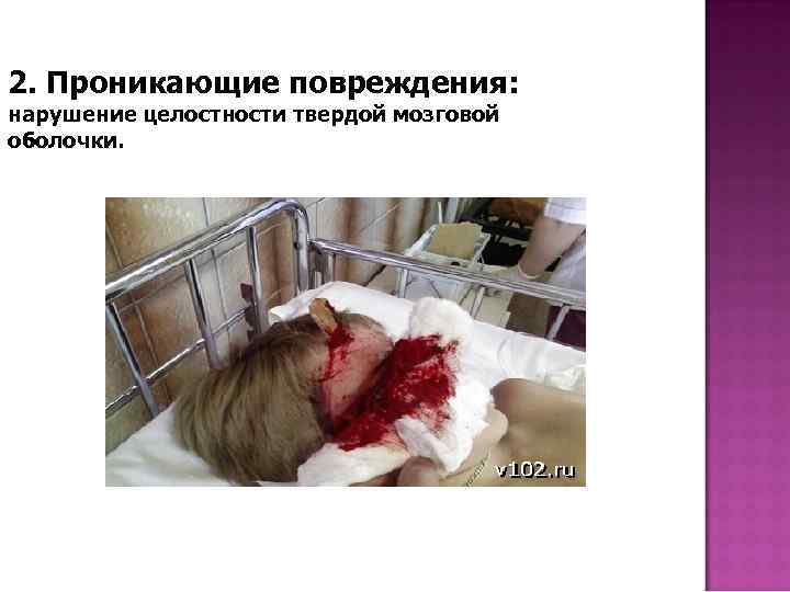 2. Проникающие повреждения: нарушение целостности твердой мозговой оболочки. 