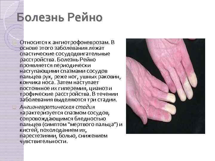 Болезнь Рейно Относится к ангиотрофоневрозам. В основе этого заболевания лежат спастические сосудодвигательные расстройства. Болезнь