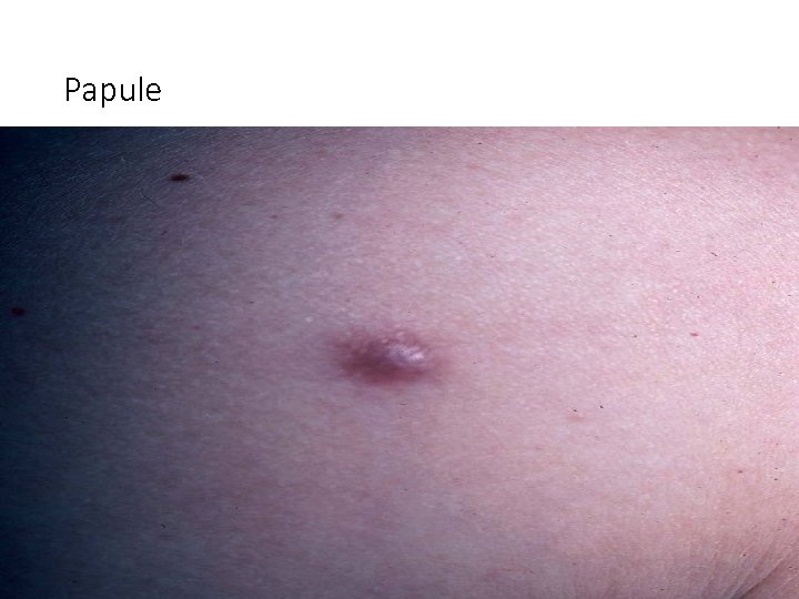 Papule 