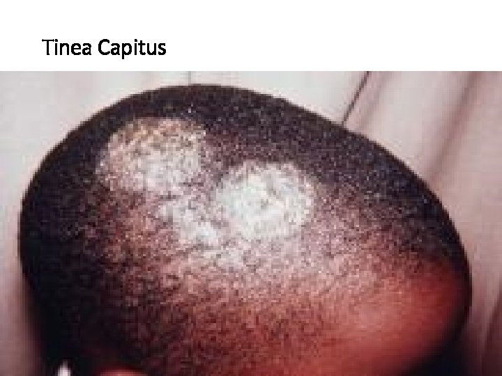 Tinea Capitus 