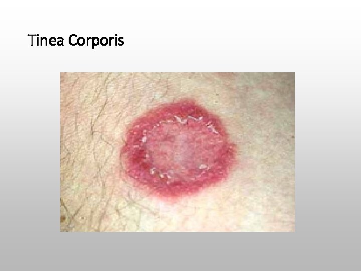 Tinea Corporis 