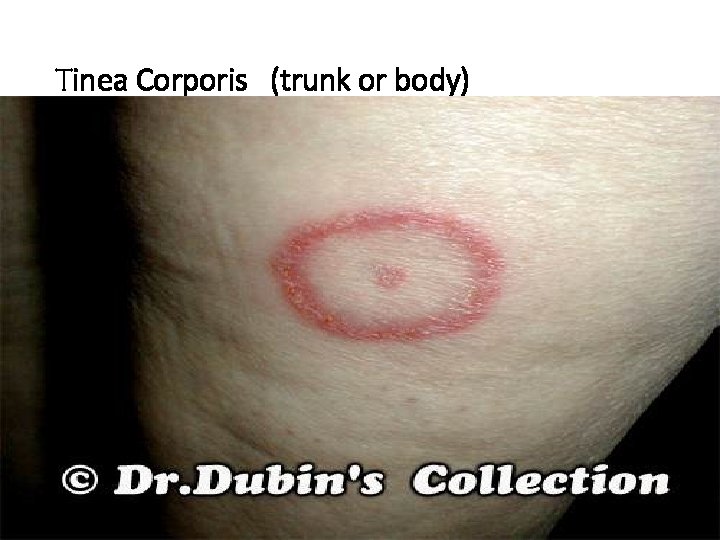 Tinea Corporis (trunk or body) 
