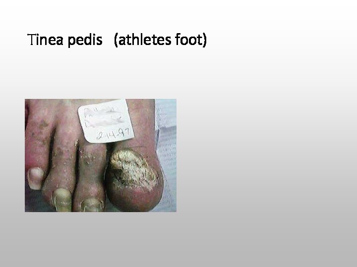 Tinea pedis (athletes foot) 