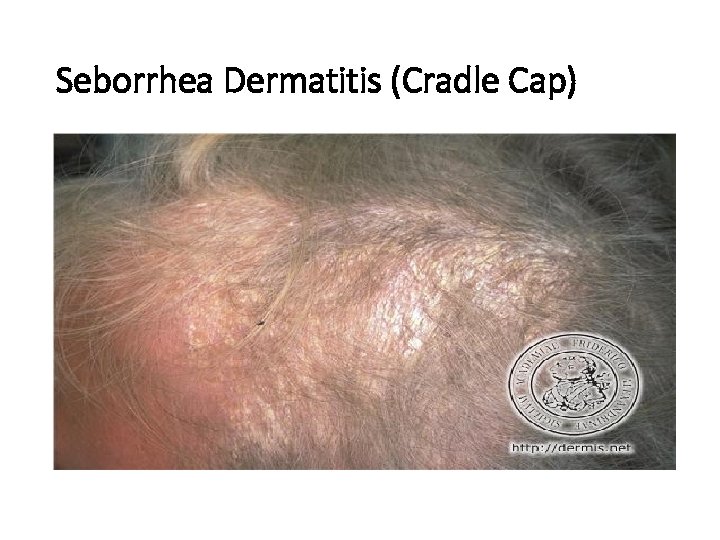 Seborrhea Dermatitis (Cradle Cap) 
