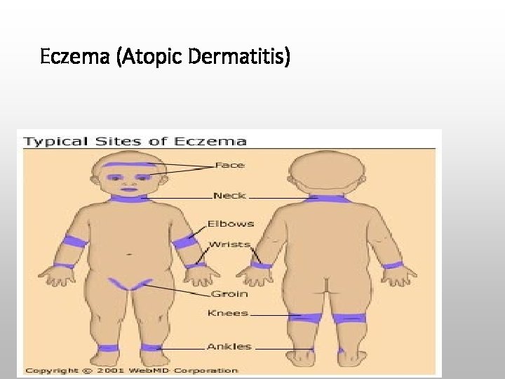Eczema (Atopic Dermatitis) 