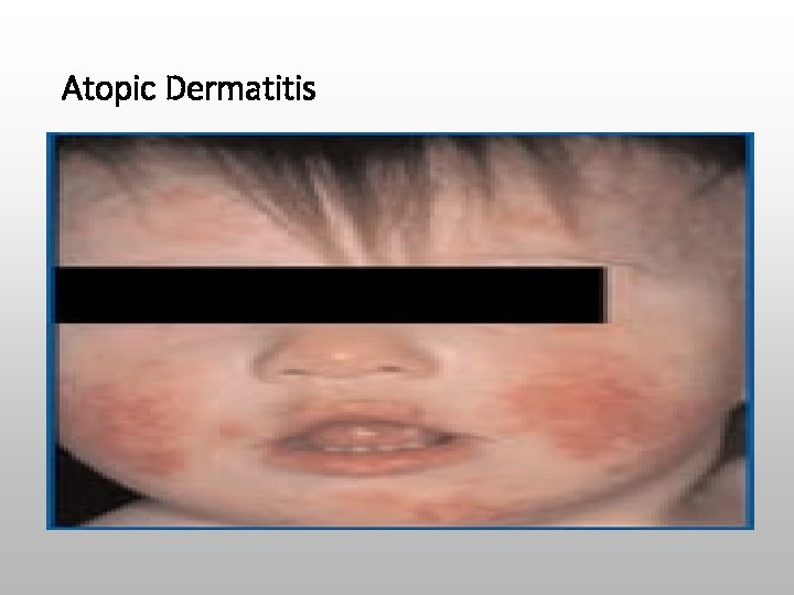 Atopic Dermatitis 