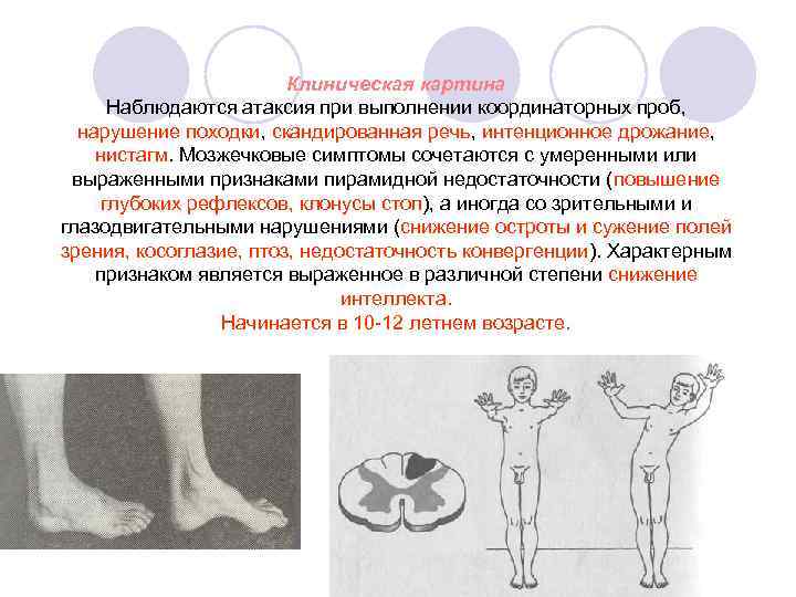 Клиническая картина Наблюдаются атаксия при выполнении координаторных проб, нарушение походки, скандированная речь, интенционное дрожание,