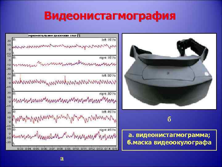 Видеонистагмография б а. видеонистагмограмма; б. маска видеоокулографа а 