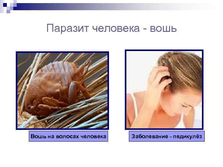 Паразит человека - вошь Вошь на волосах человека Заболевание - педикулёз 