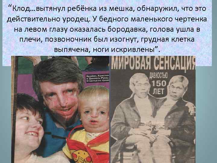 “Клод…вытянул ребёнка из мешка, обнаружил, что это действительно уродец. У бедного маленького чертенка на