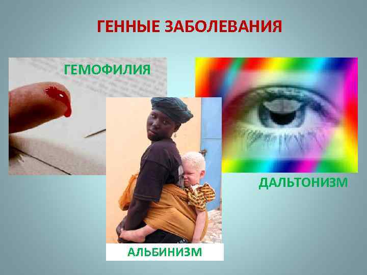 ГЕННЫЕ ЗАБОЛЕВАНИЯ ГЕМОФИЛИЯ ДАЛЬТОНИЗМ АЛЬБИНИЗМ 