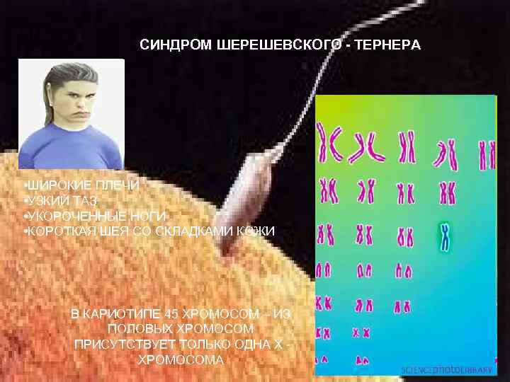 СИНДРОМ ШЕРЕШЕВСКОГО - ТЕРНЕРА • ШИРОКИЕ ПЛЕЧИ • УЗКИЙ ТАЗ • УКОРОЧЕННЫЕ НОГИ •